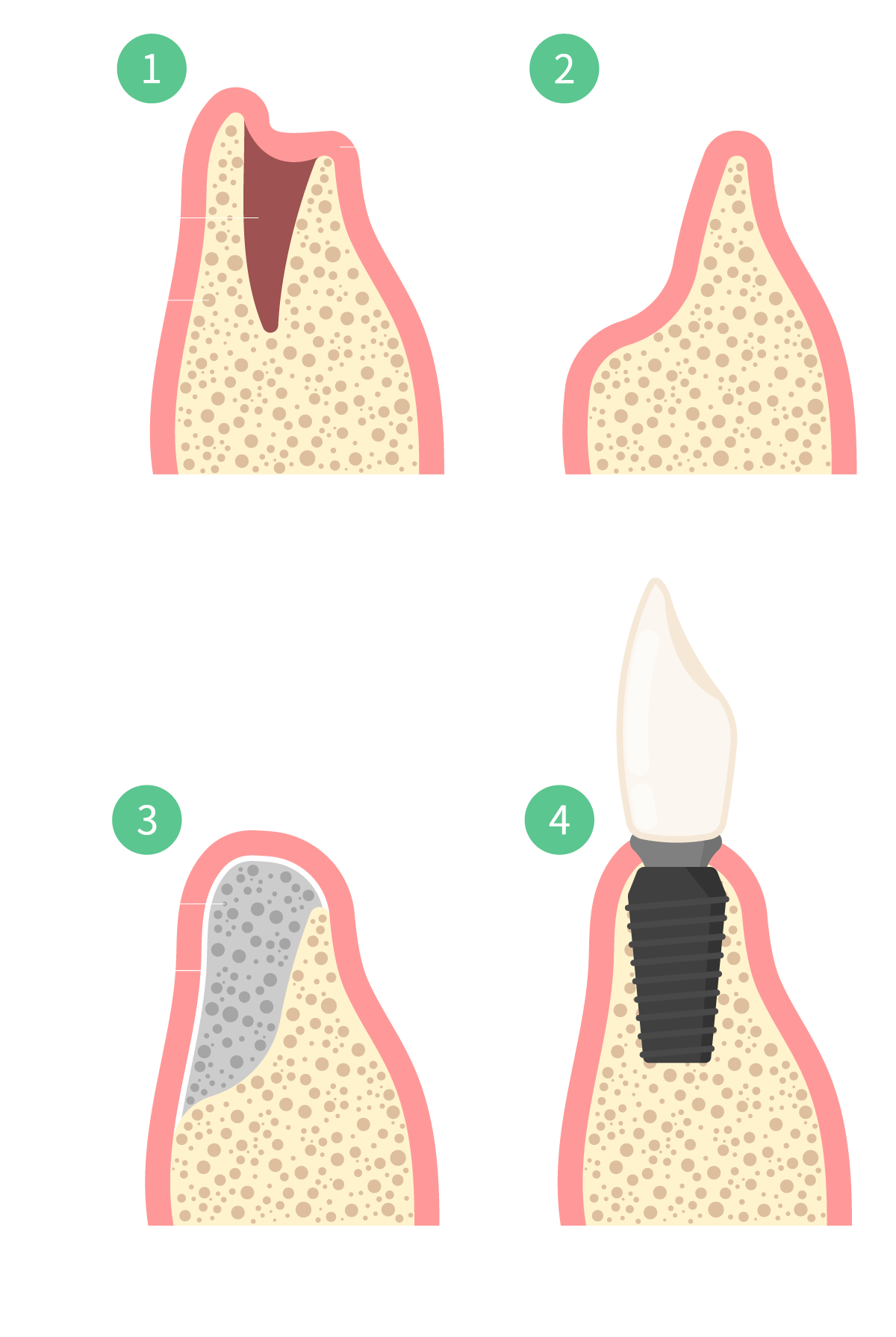 Garden Grove Implant bone grafting