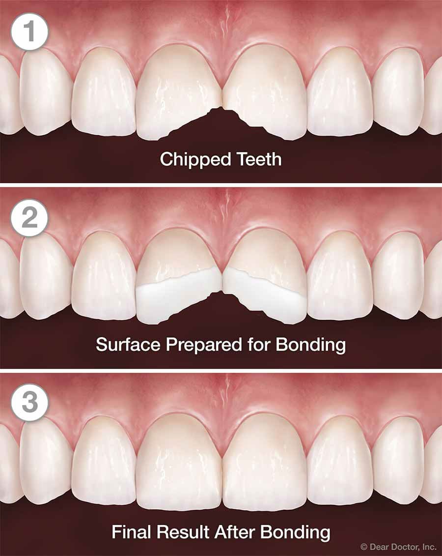 Garden Grove Cosmetic Bonding