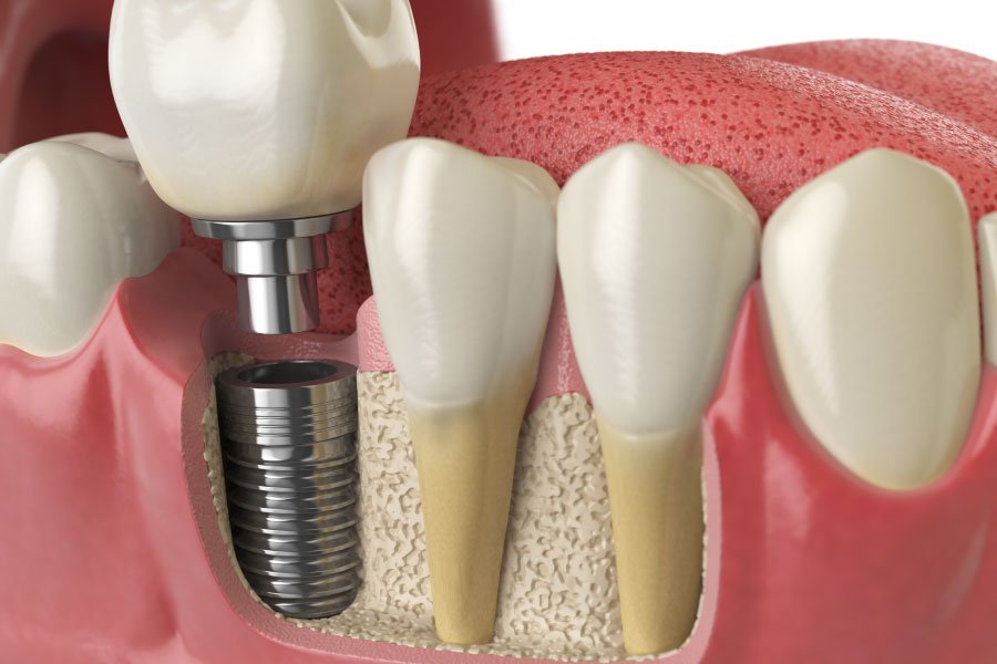 Garden Grove Implant Overview