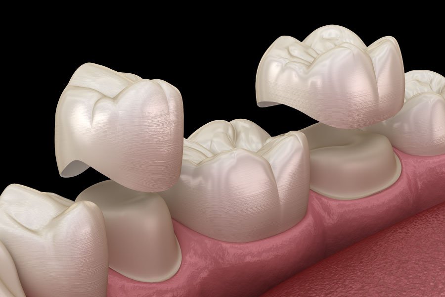 Garden Grove Porcelain Crowns