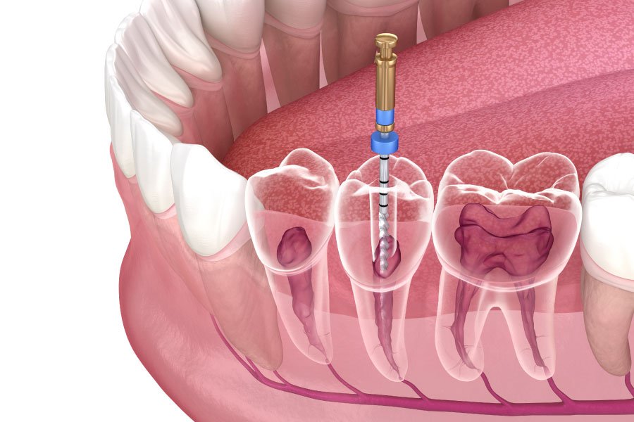 Garden Grove Root Canals