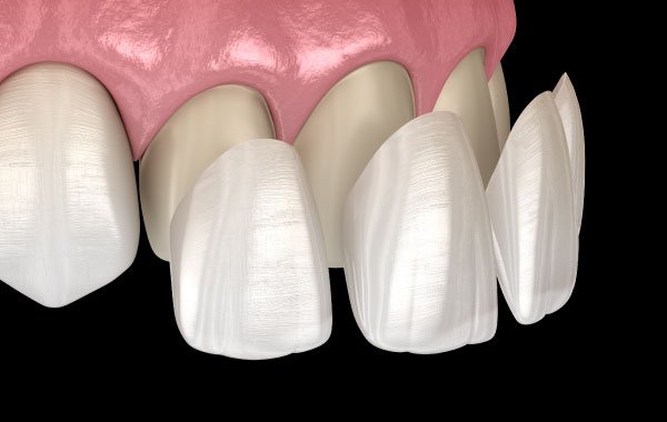 Garden Grove Porcelain Veneers